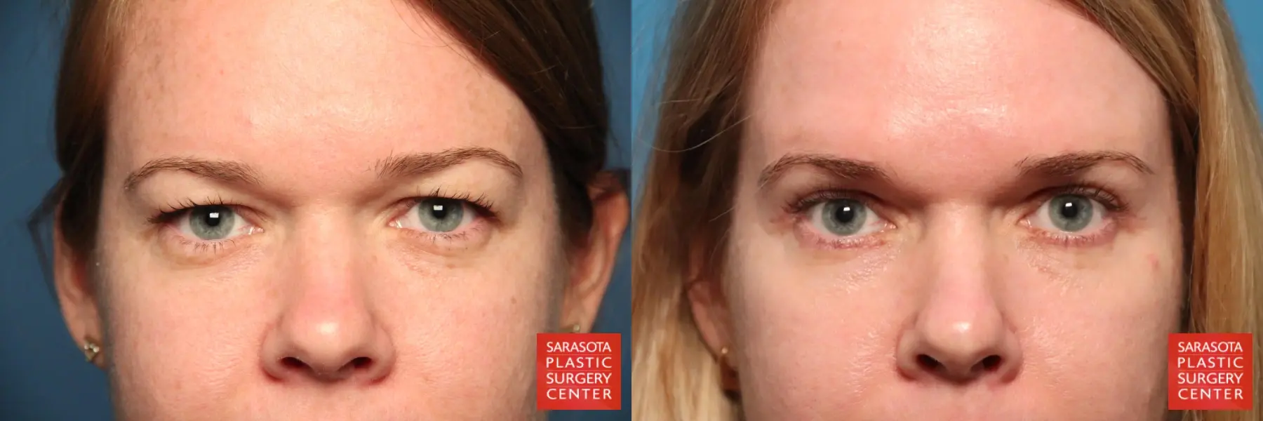 Blepharoplasty: Patient 28 - Before and After  