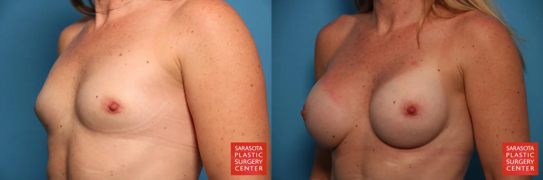 Breast Augmentation: Patient 62 - Before and After 2