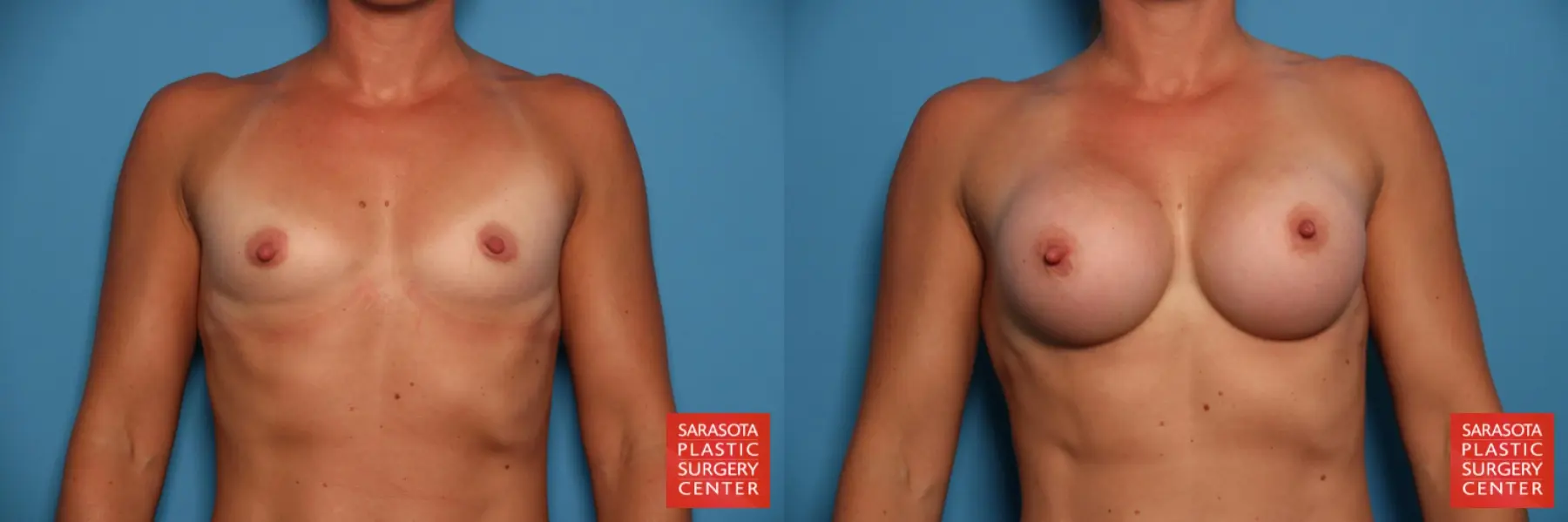 Breast Augmentation: Patient 67 - Before and After 1