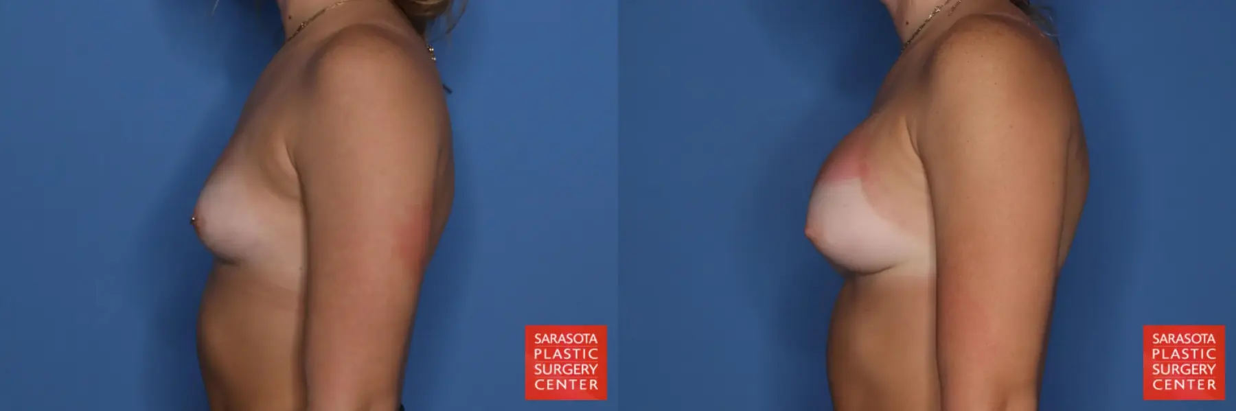 Breast Augmentation: Patient 211 - Before and After 3