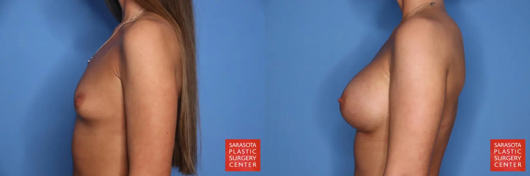 Breast Augmentation: Patient 213 - Before and After 5