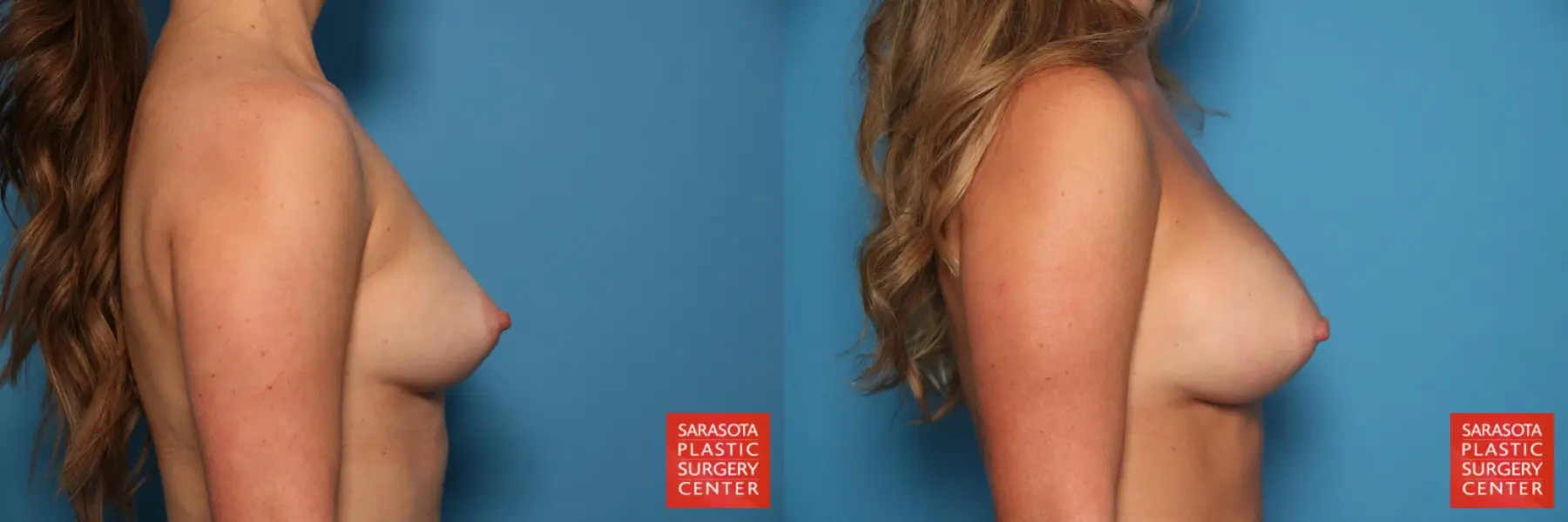 Breast Augmentation: Patient 52 - Before and After 3