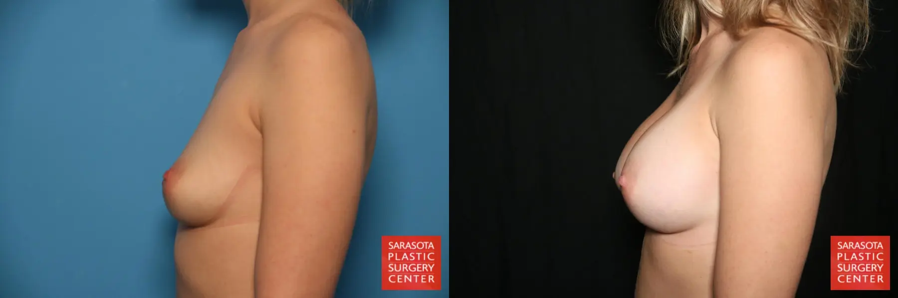 Breast Augmentation: Patient 30 - Before and After 3