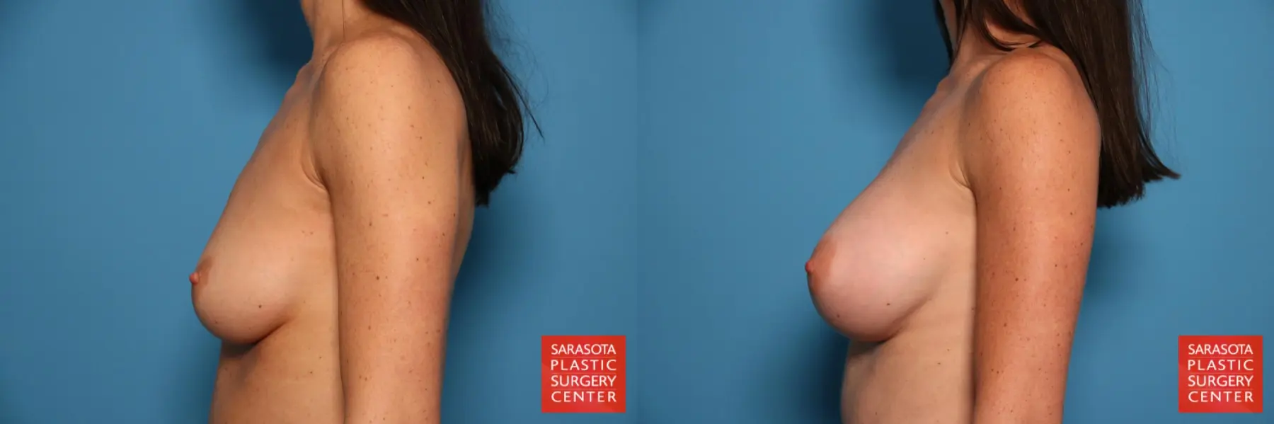Breast Augmentation: Patient 17 - Before and After 3