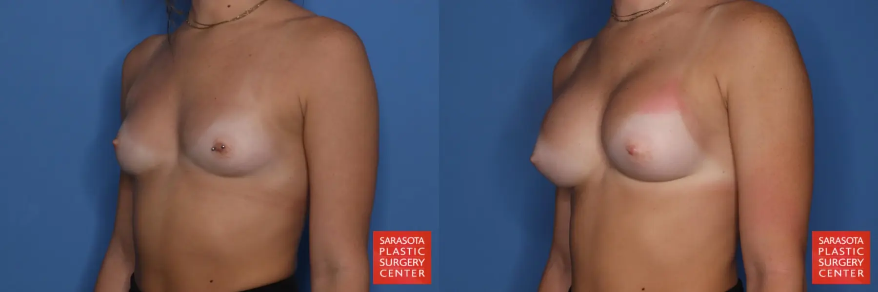 Breast Augmentation: Patient 211 - Before and After 2