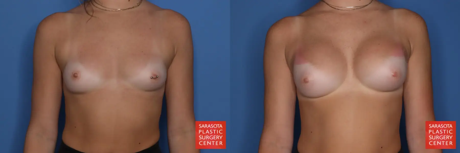 Breast Augmentation: Patient 211 - Before and After 1