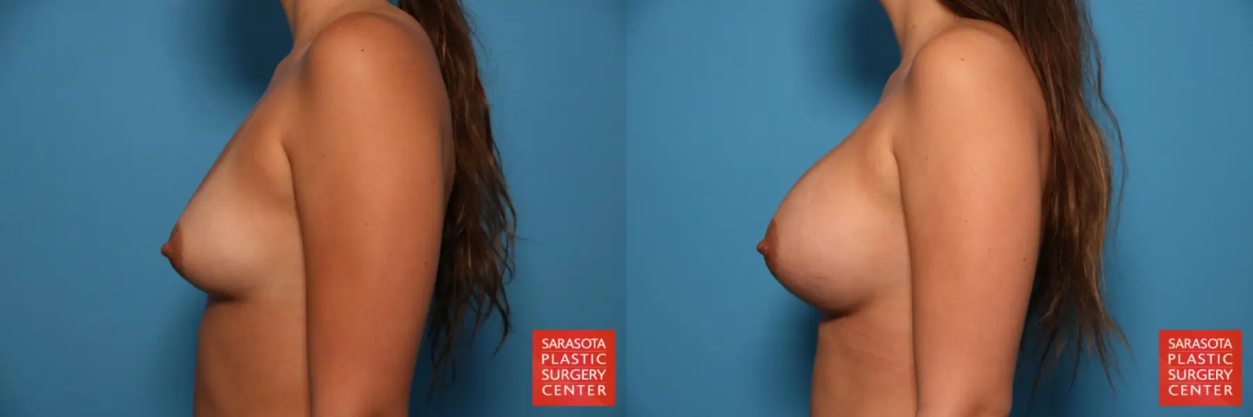 Breast Augmentation: Patient 25 - Before and After 3