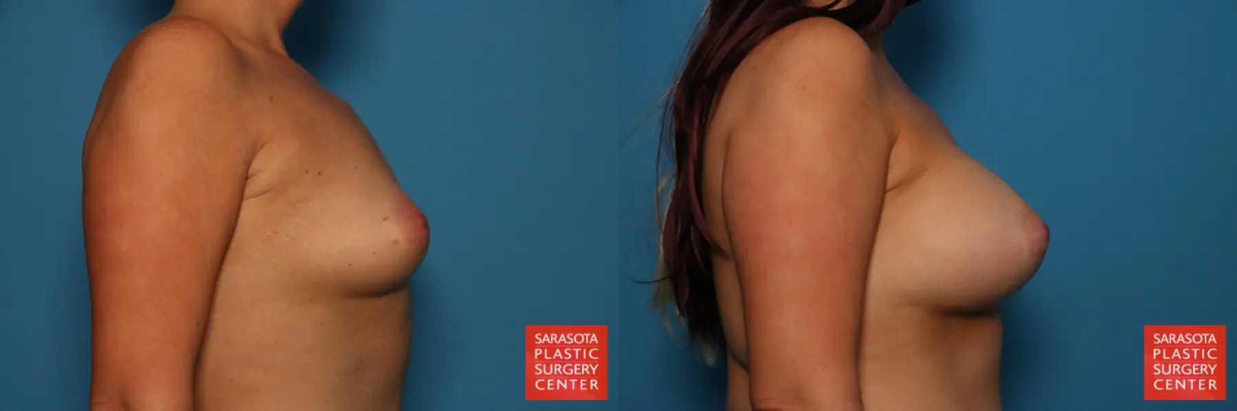 Breast Augmentation: Patient 87 - Before and After 3