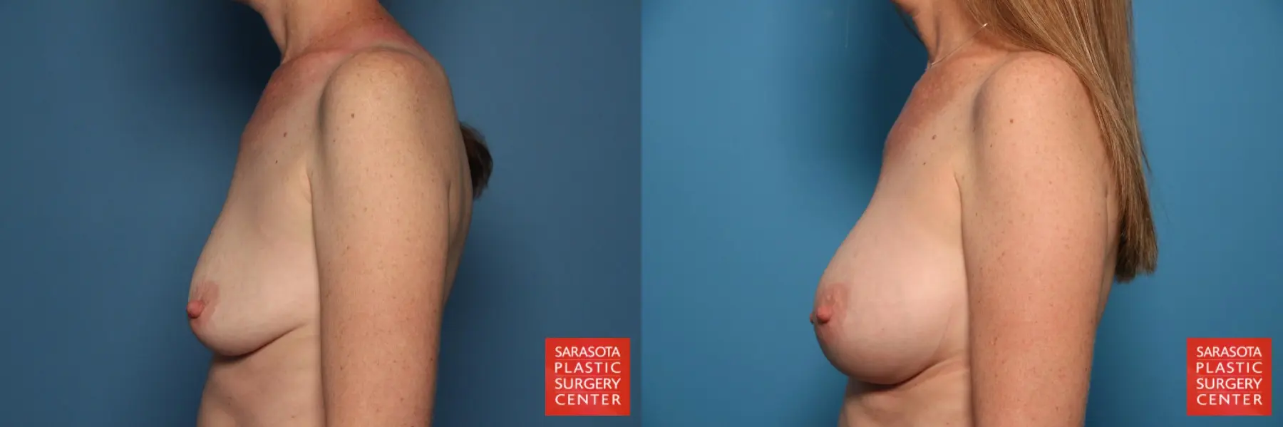 Breast Augmentation: Patient 77 - Before and After 3
