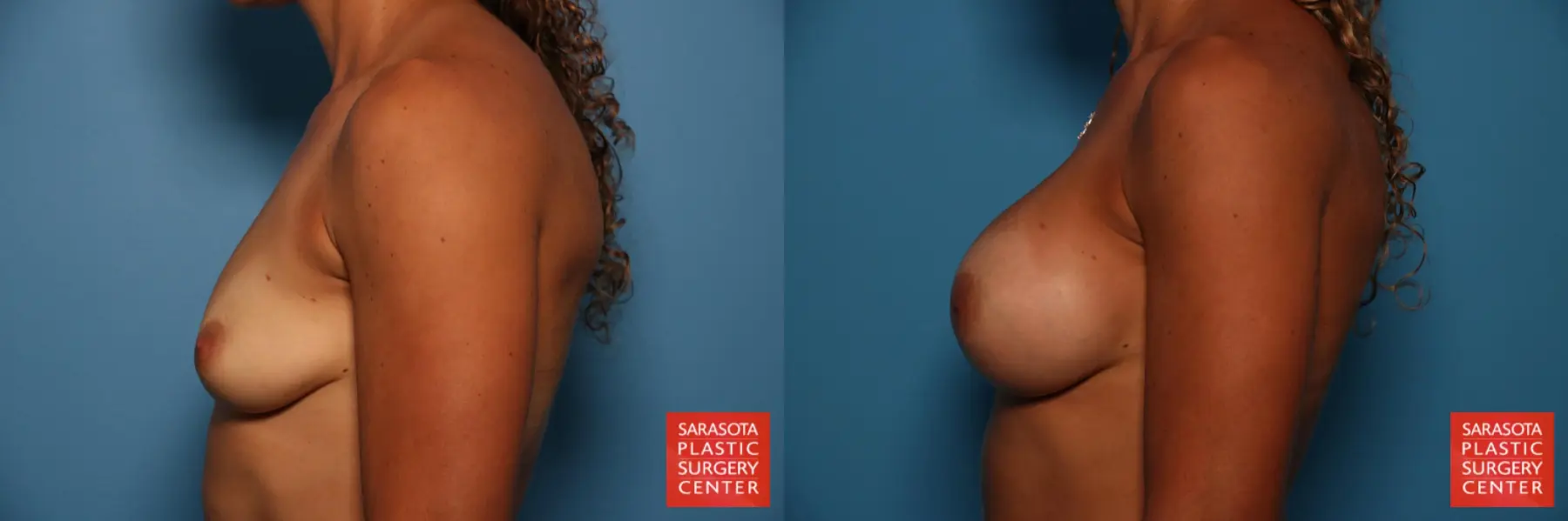 Breast Augmentation: Patient 19 - Before and After 3