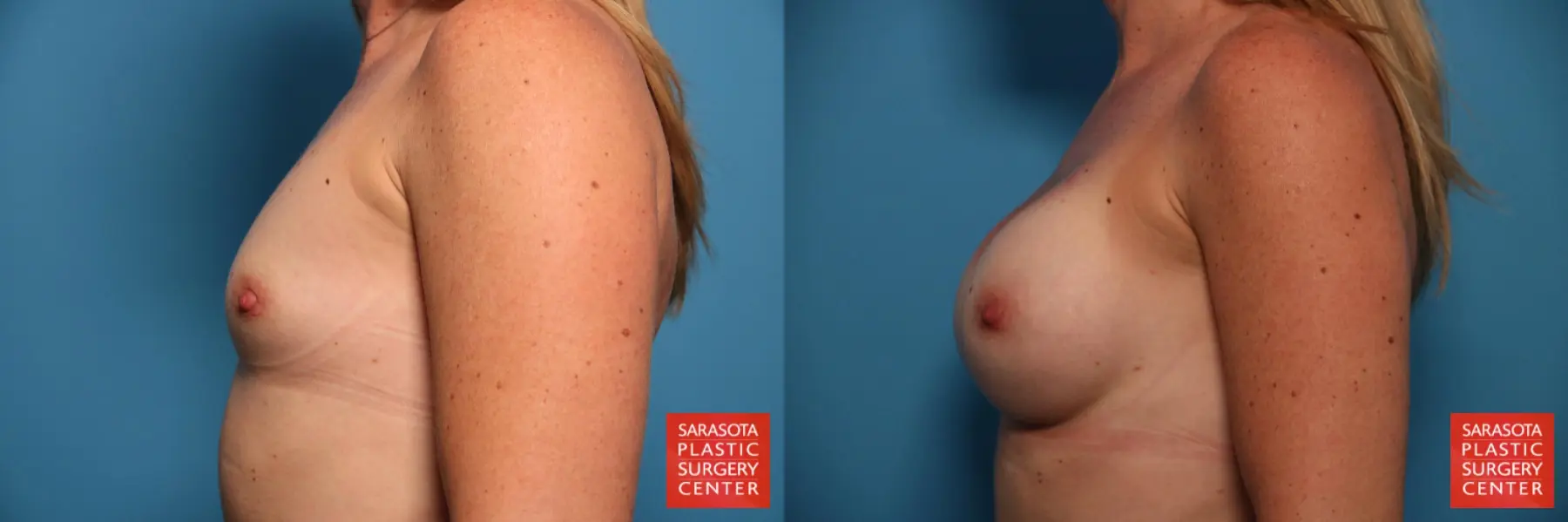 Breast Augmentation: Patient 62 - Before and After 3