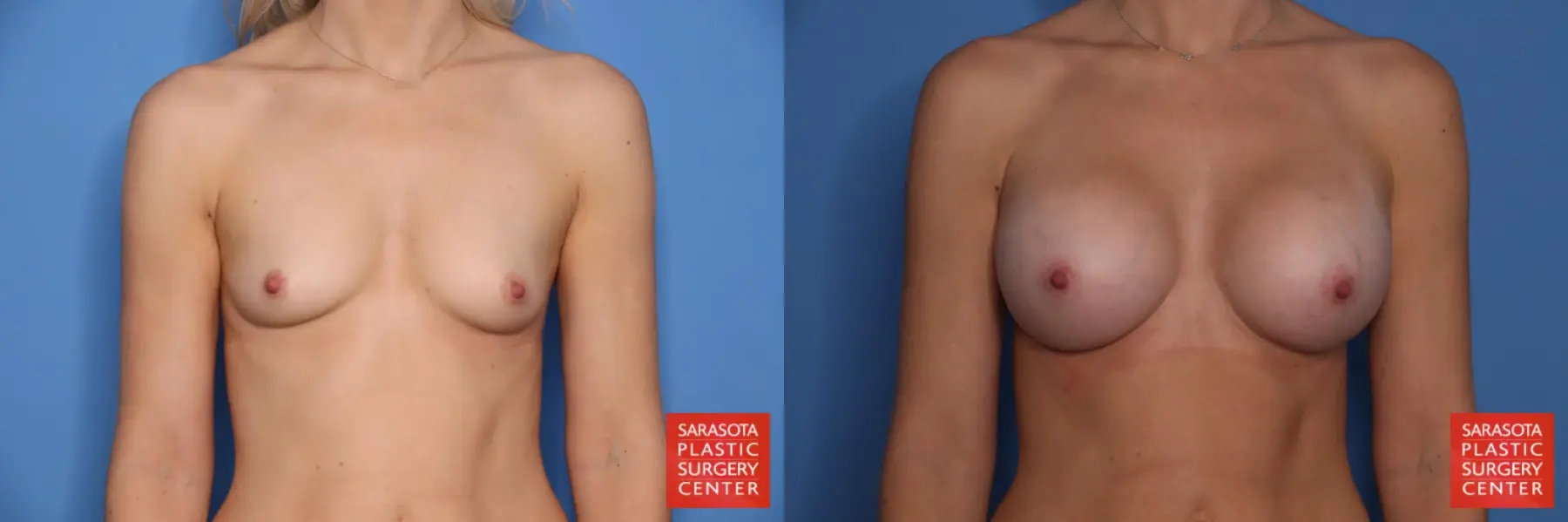 Breast Augmentation: Patient 207 - Before and After 1