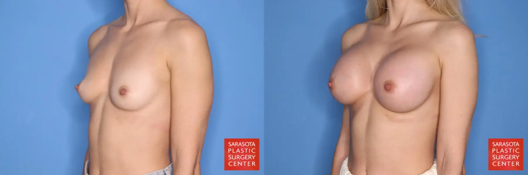 Breast Augmentation: Patient 205 - Before and After 2