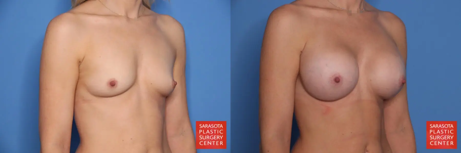 Breast Augmentation: Patient 207 - Before and After 2