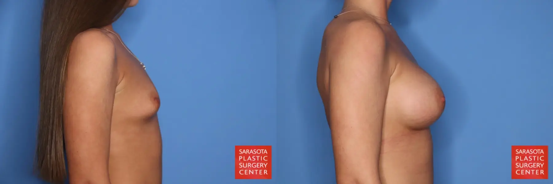 Breast Augmentation: Patient 213 - Before and After 3
