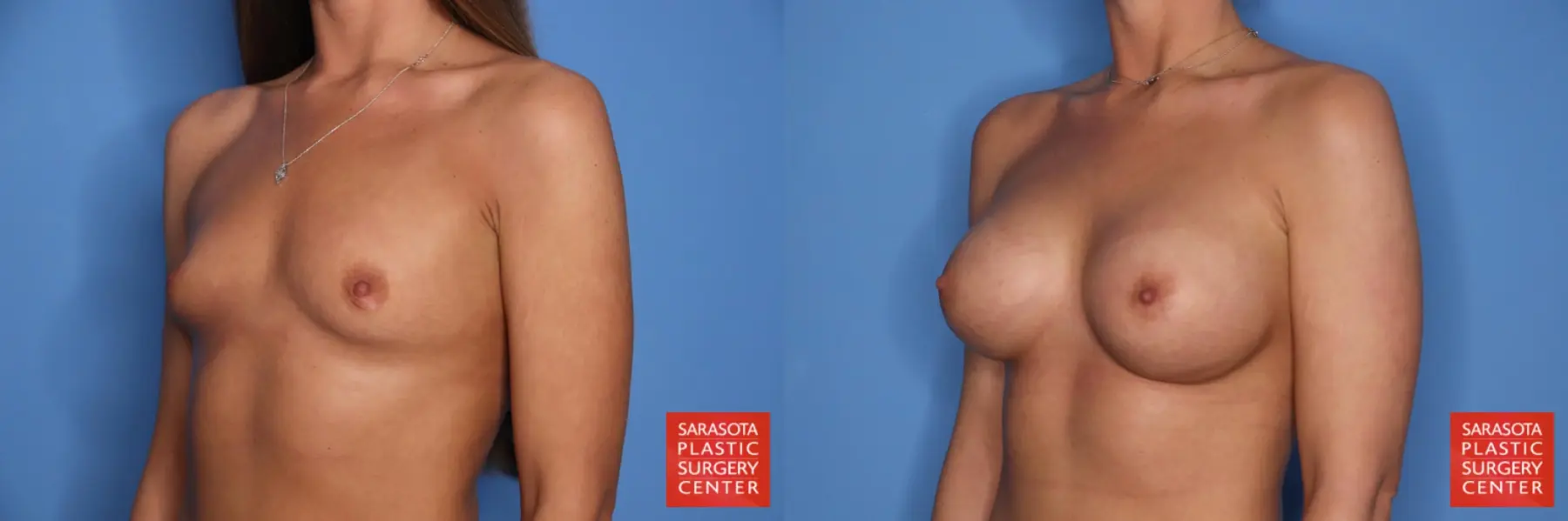 Breast Augmentation: Patient 213 - Before and After 4