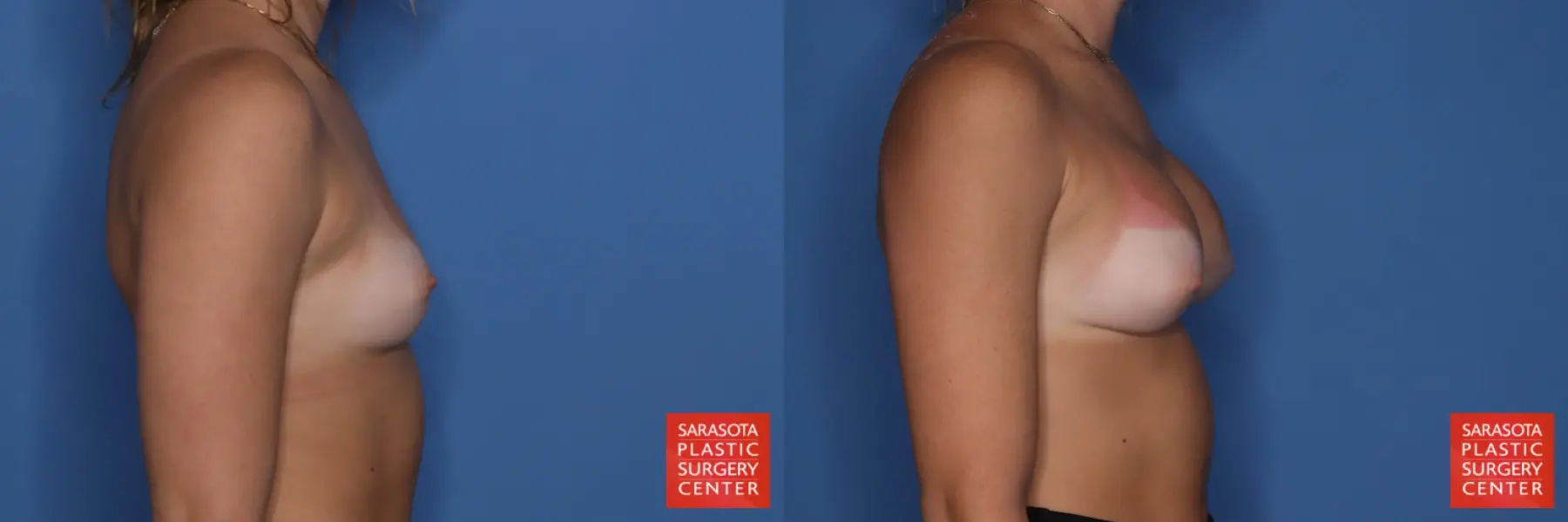 Breast Augmentation: Patient 211 - Before and After 5