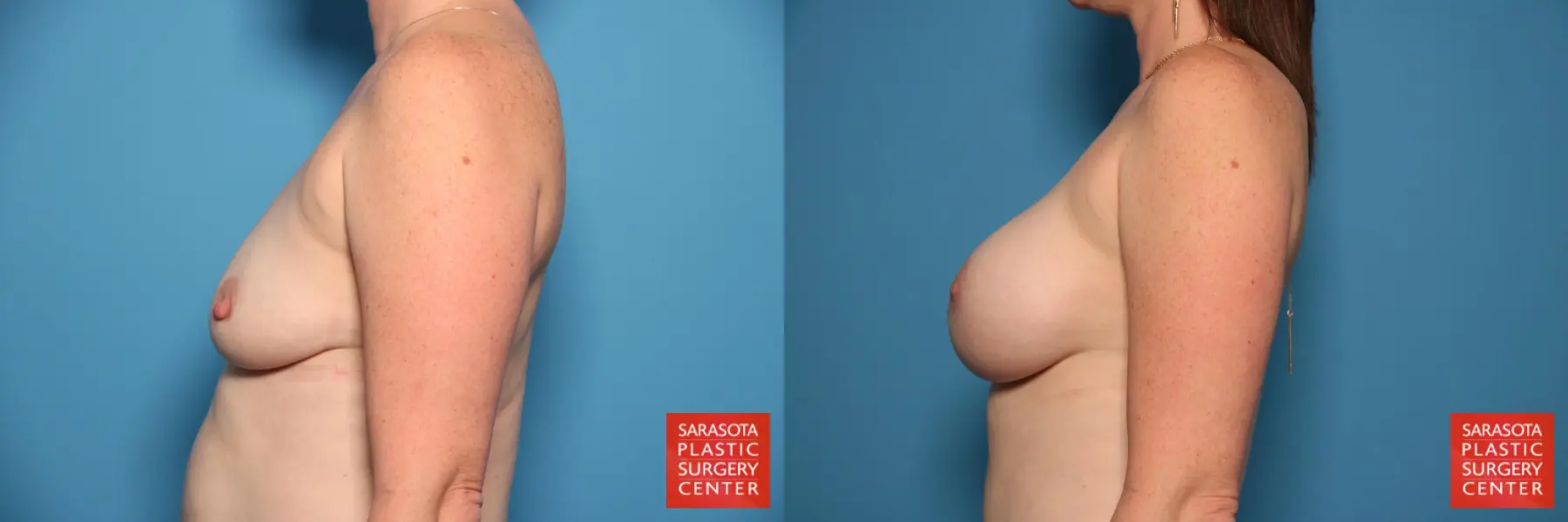 Breast Augmentation: Patient 39 - Before and After 3