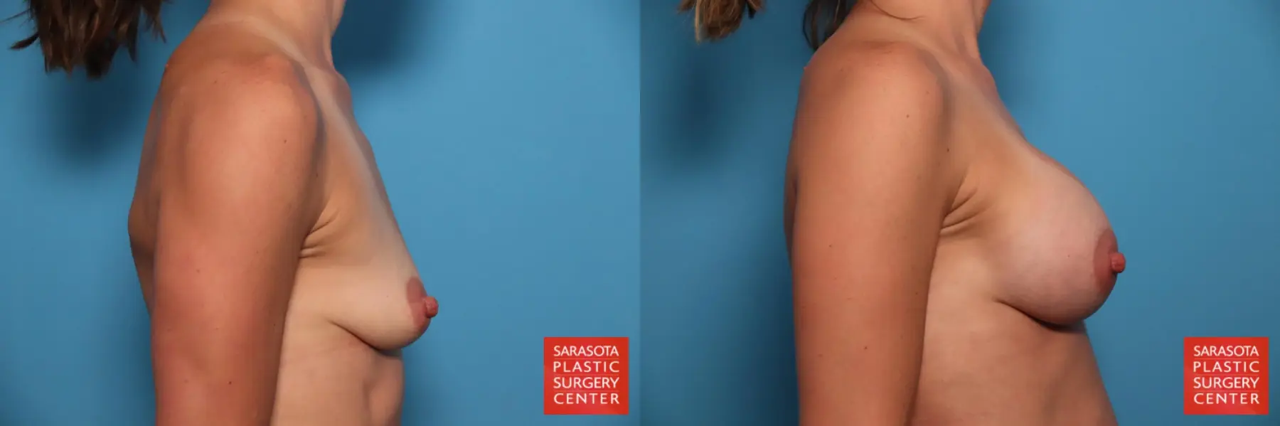 Breast Augmentation: Patient 91 - Before and After 3