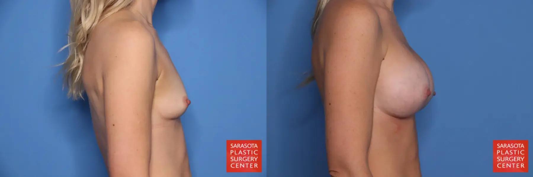 Breast Augmentation: Patient 207 - Before and After 3
