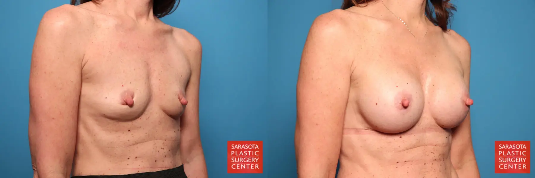 Breast Augmentation: Patient 70 - Before and After 1