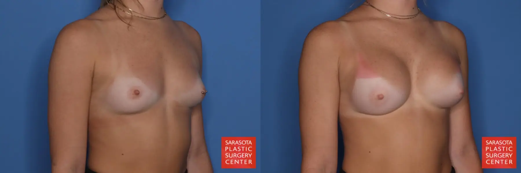 Breast Augmentation: Patient 211 - Before and After 4