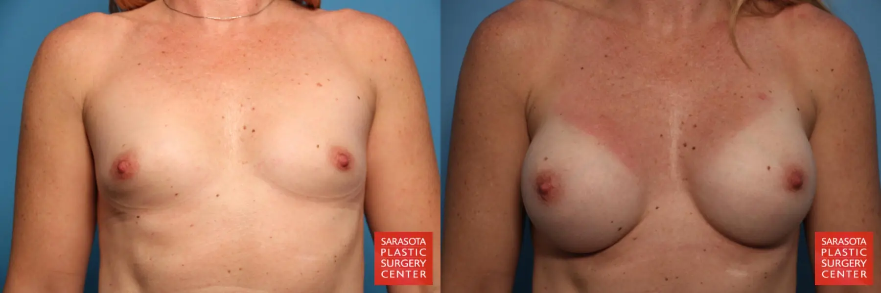 Breast Augmentation: Patient 62 - Before and After 1