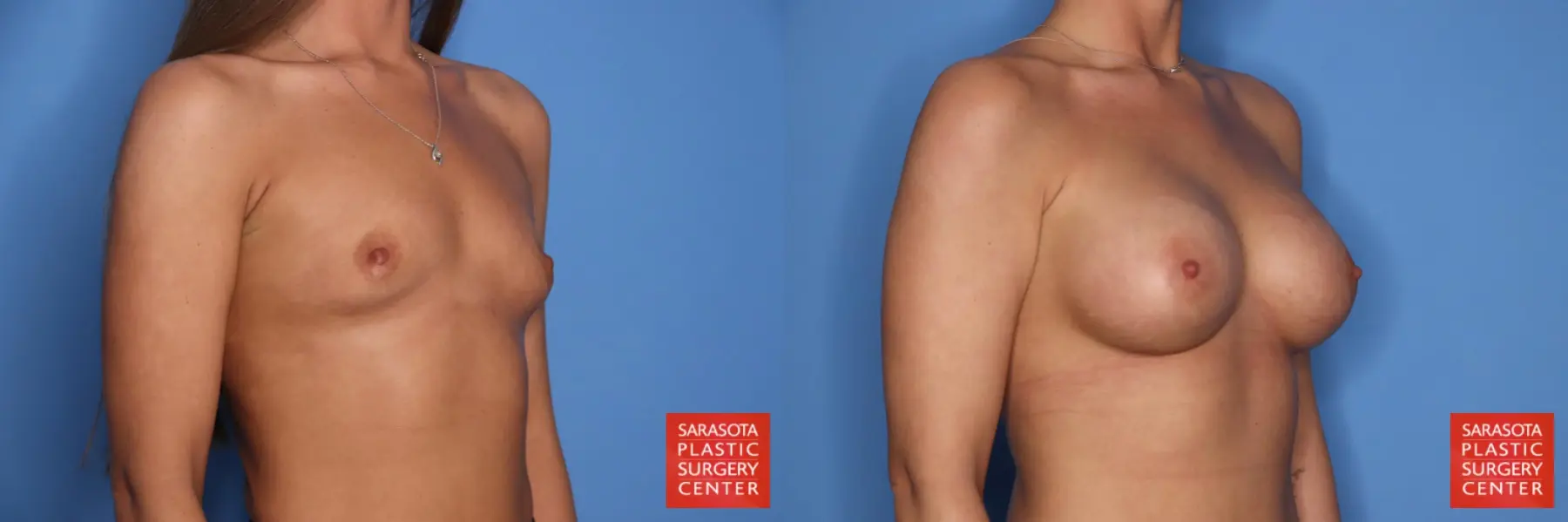 Breast Augmentation: Patient 213 - Before and After 2