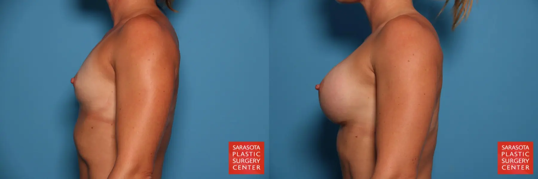 Breast Augmentation: Patient 67 - Before and After 3