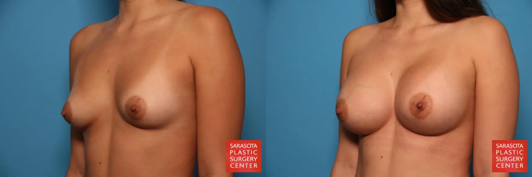 Breast Augmentation: Patient 25 - Before and After 2