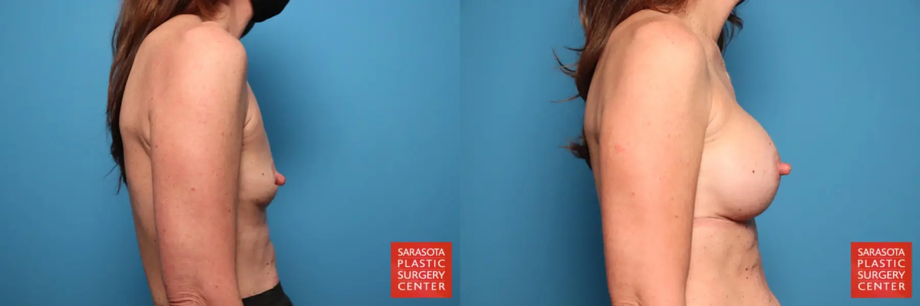 Breast Augmentation: Patient 70 - Before and After 2