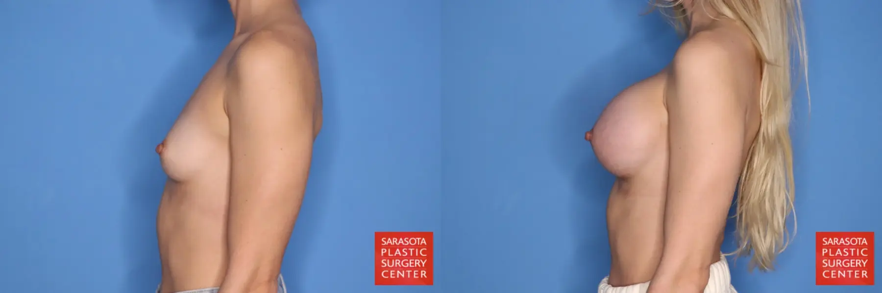 Breast Augmentation: Patient 205 - Before and After 3