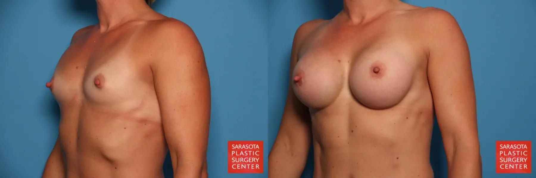 Breast Augmentation: Patient 67 - Before and After 2