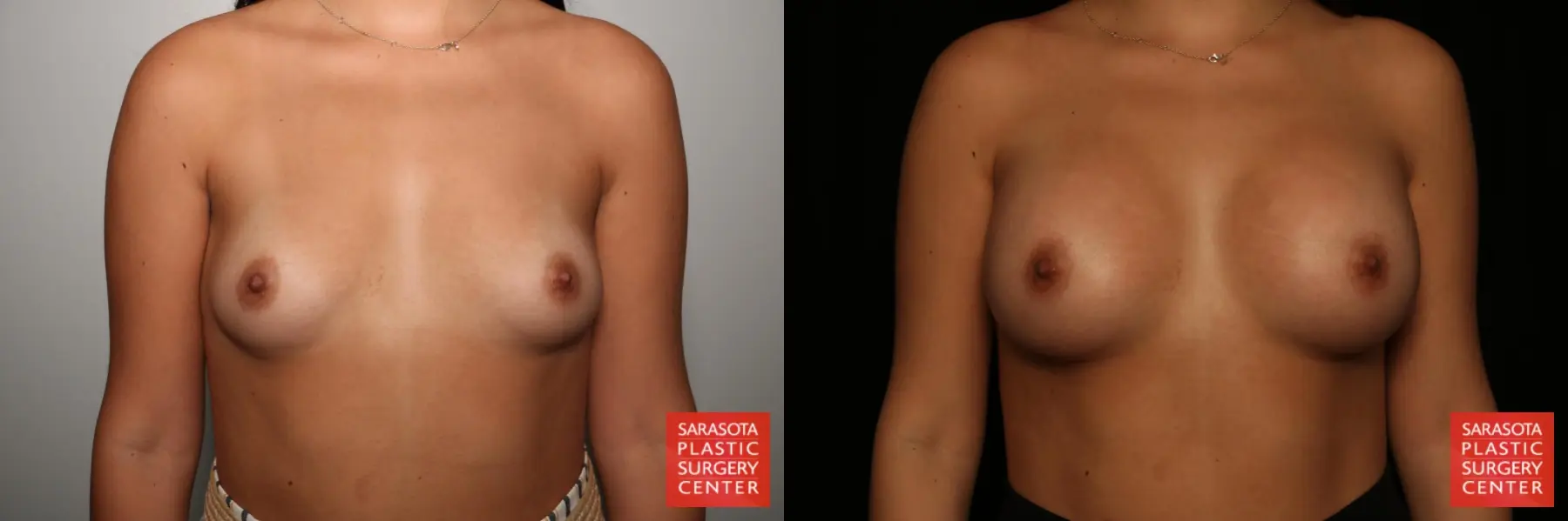 Breast Augmentation: Patient 4 - Before and After  