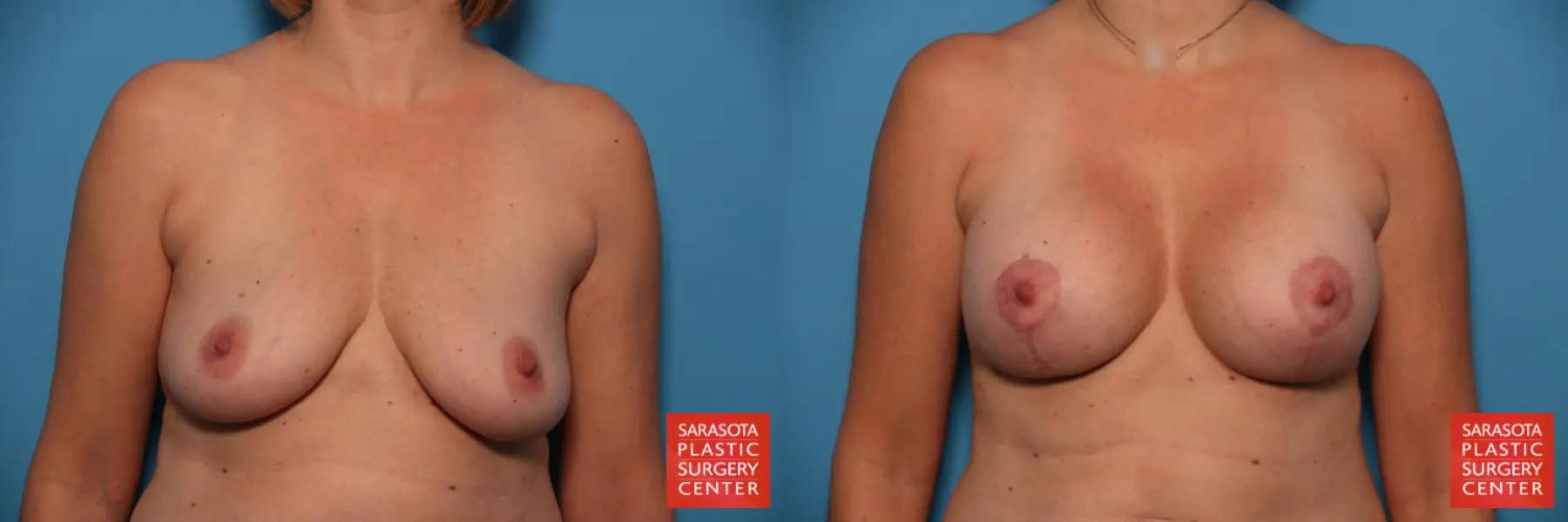 Breast Augmentation With Lift: Patient 23 - Before and After  