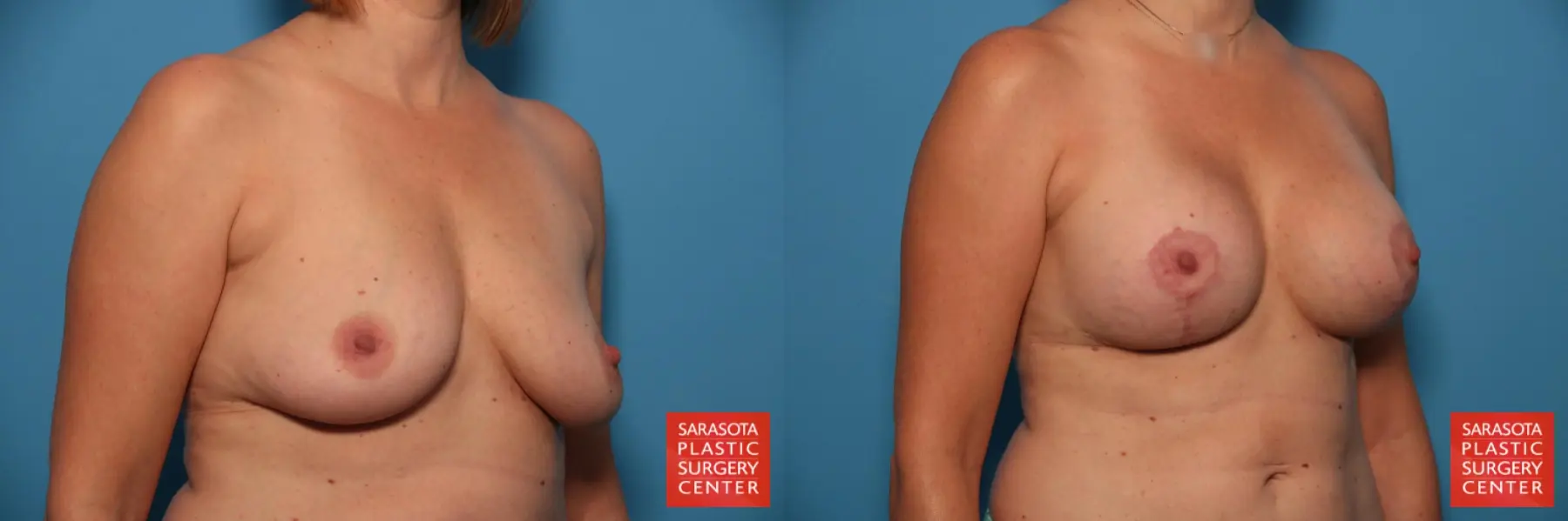 Breast Augmentation With Lift: Patient 23 - Before and After 2