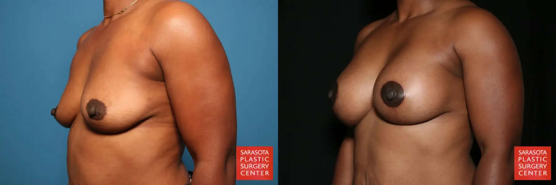 Breast Augmentation With Lift: Patient 35 - Before and After 2