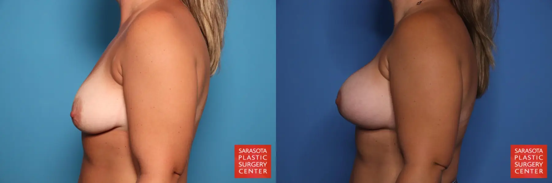 Breast Augmentation With Lift: Patient 89 - Before and After 3