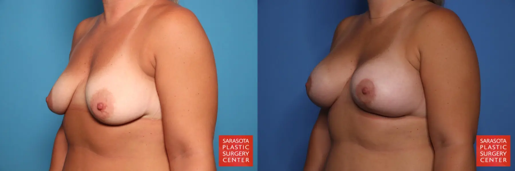 Breast Augmentation With Lift: Patient 89 - Before and After 2