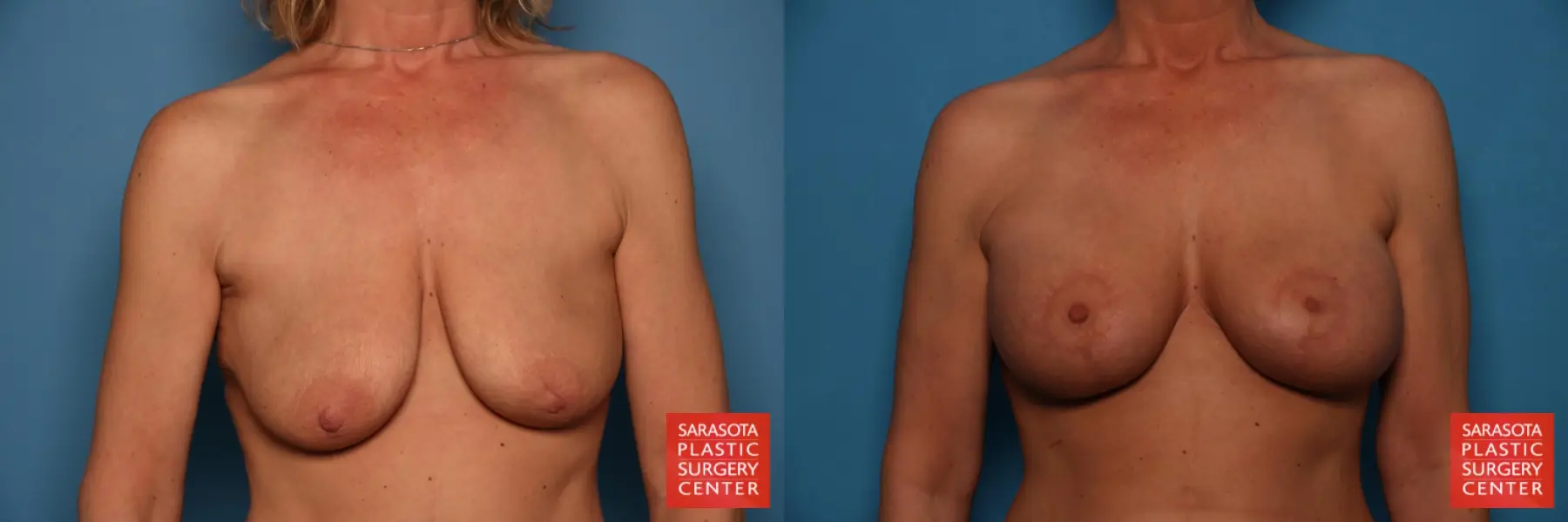 Breast Augmentation With Lift: Patient 26 - Before and After  