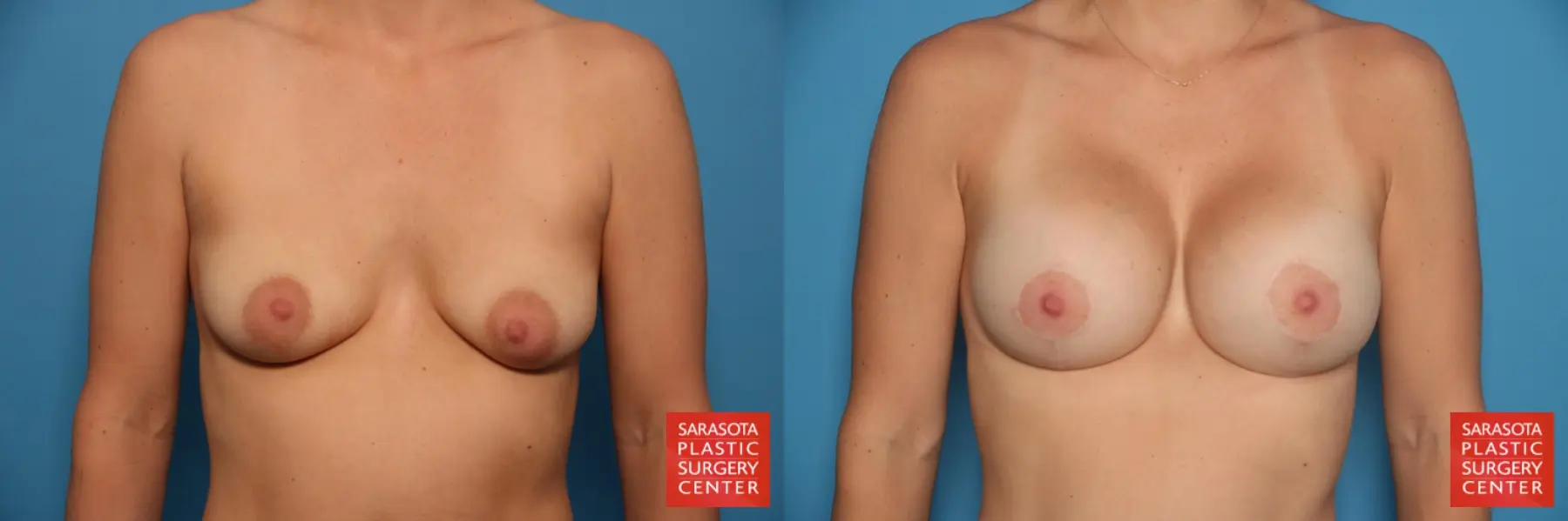 Breast Augmentation With Lift: Patient 14 - Before and After  