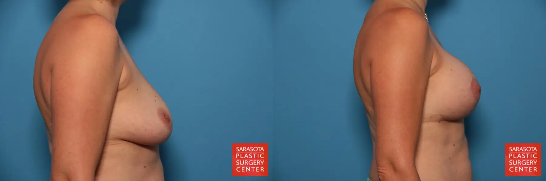 Breast Augmentation With Lift: Patient 23 - Before and After 3