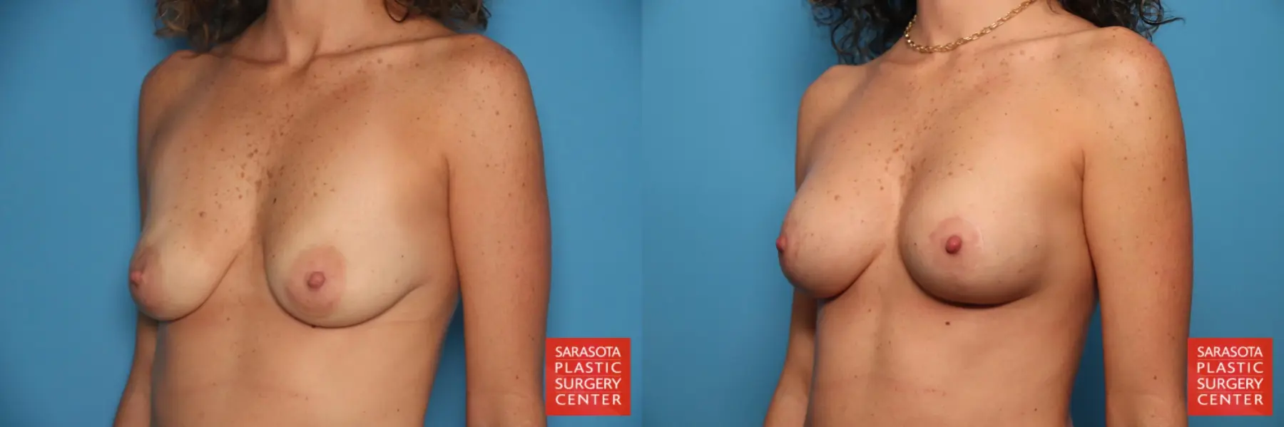 Breast Augmentation With Lift: Patient 6 - Before and After 2