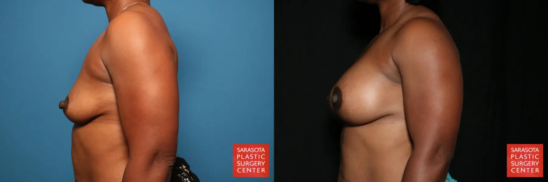Breast Augmentation With Lift: Patient 35 - Before and After 3