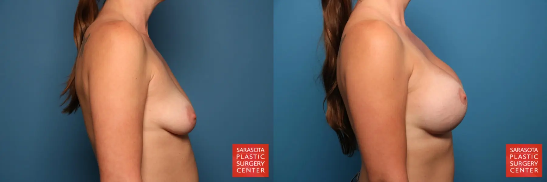 Breast Augmentation With Lift: Patient 34 - Before and After 5