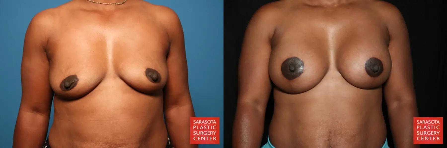 Breast Augmentation With Lift: Patient 35 - Before and After  