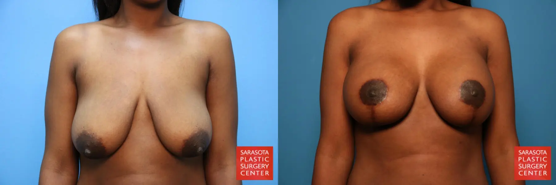 Breast Augmentation With Lift: Patient 29 - Before and After  