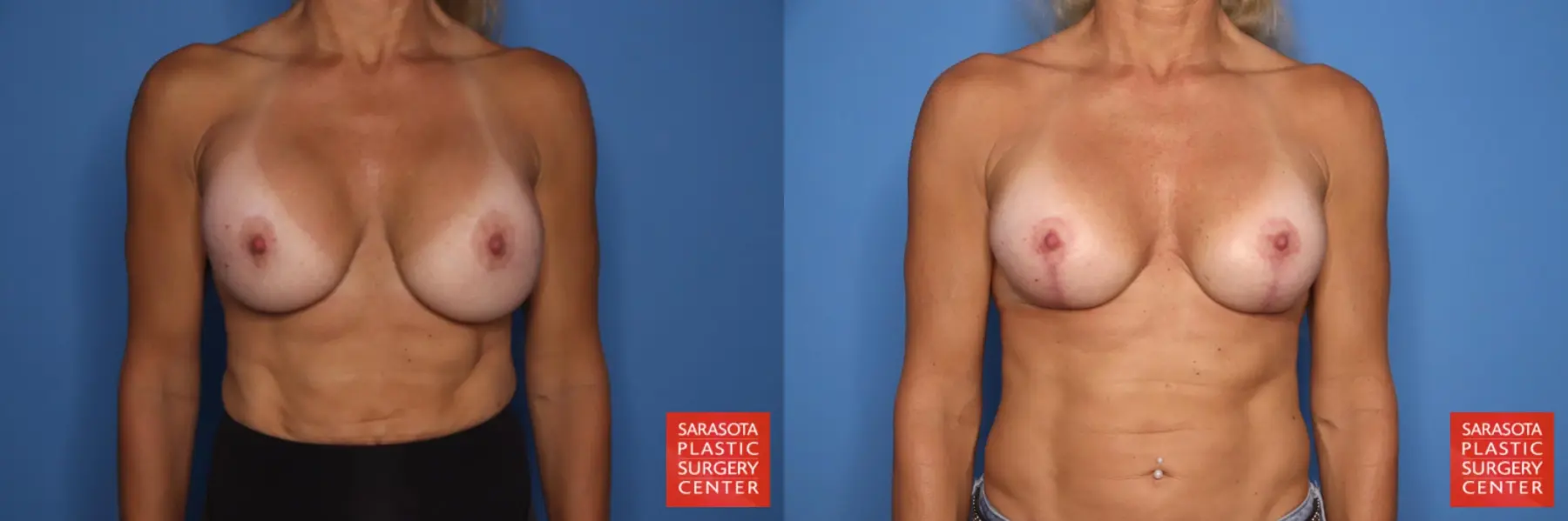 Breast Implant Exchange: Patient 2 - Before and After  