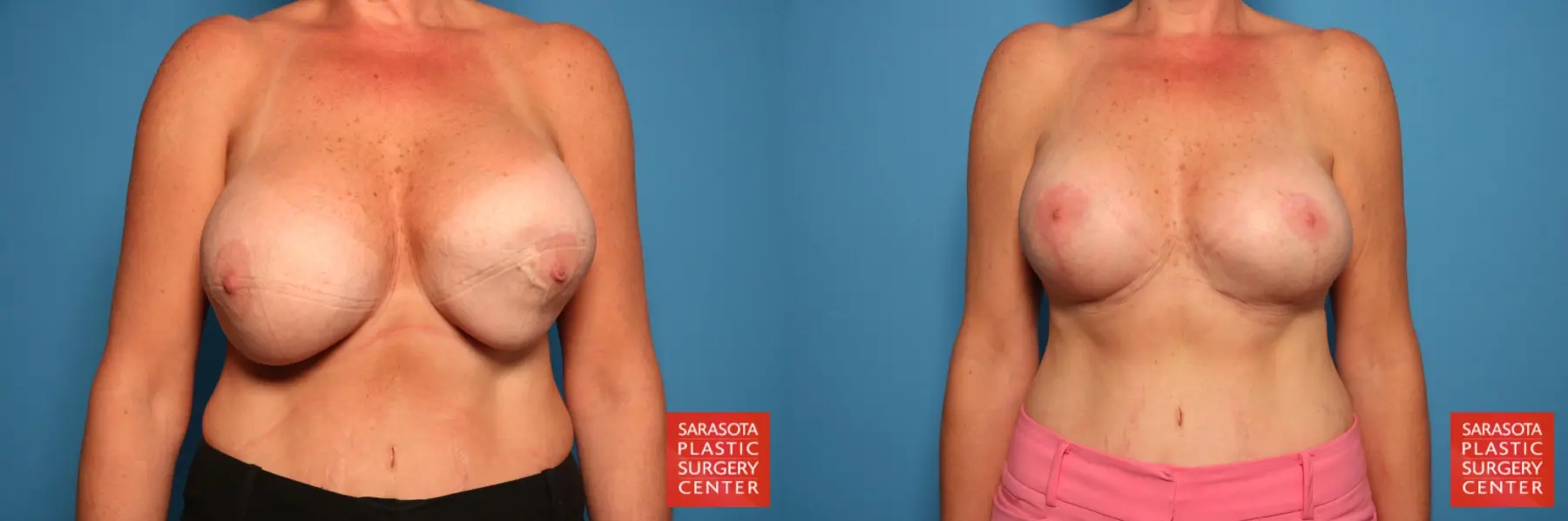 Breast Implant Exchange: Patient 21 - Before and After  