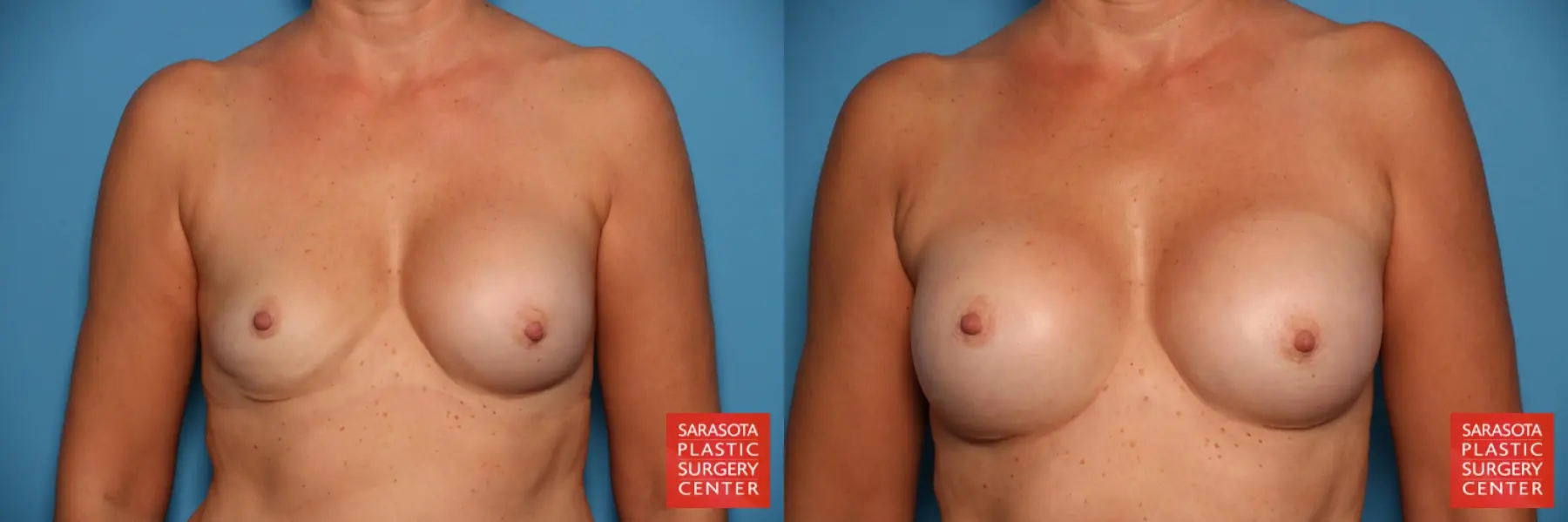 Breast Implant Exchange: Patient 18 - Before and After  